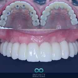 Same Day Teeth | Dental Implants Leeds | Infinity Dental Clinic